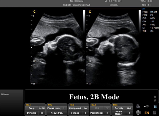 2D, 3D ve 4D ultrason taramaları arasındaki farklar nelerdir?